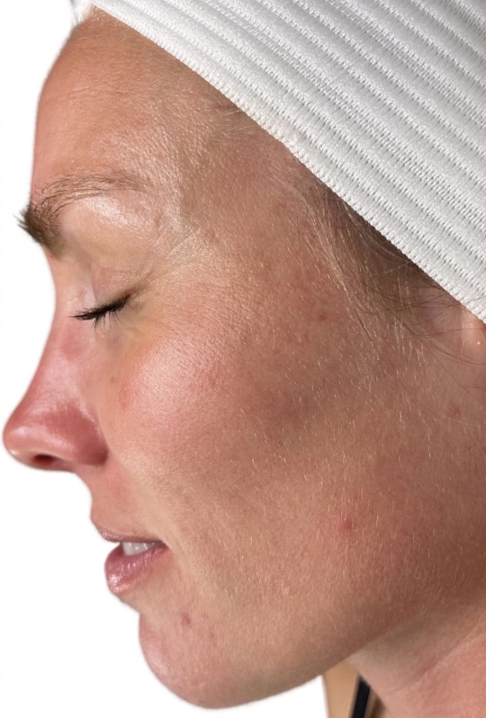After Image: Acne Chemical Peel - left-front-oblique