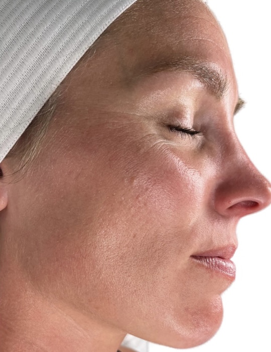 After Image: Acne Chemical Peel - right-front-oblique