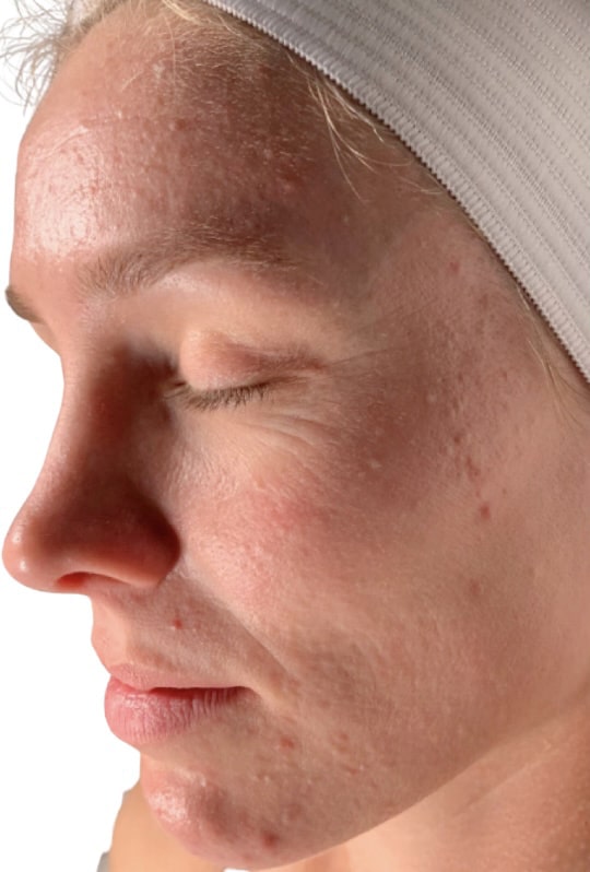 Before Image: Acne Chemical Peel - left-front-oblique