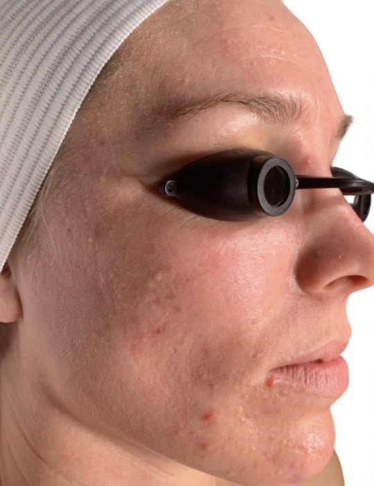 Before Image: Acne Chemical Peel - right-front-oblique