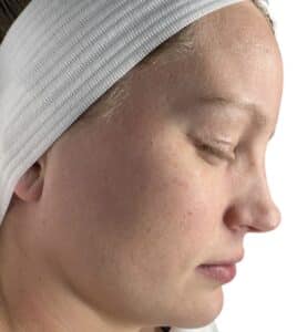 After Image: Chemical Peel