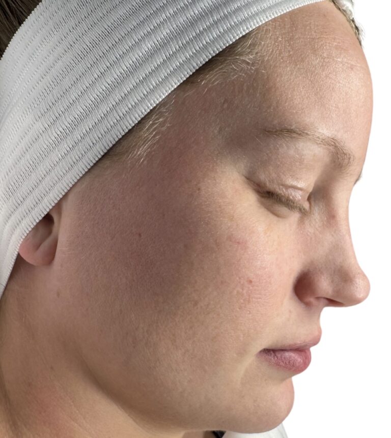 After Image: Chemical Peel - front