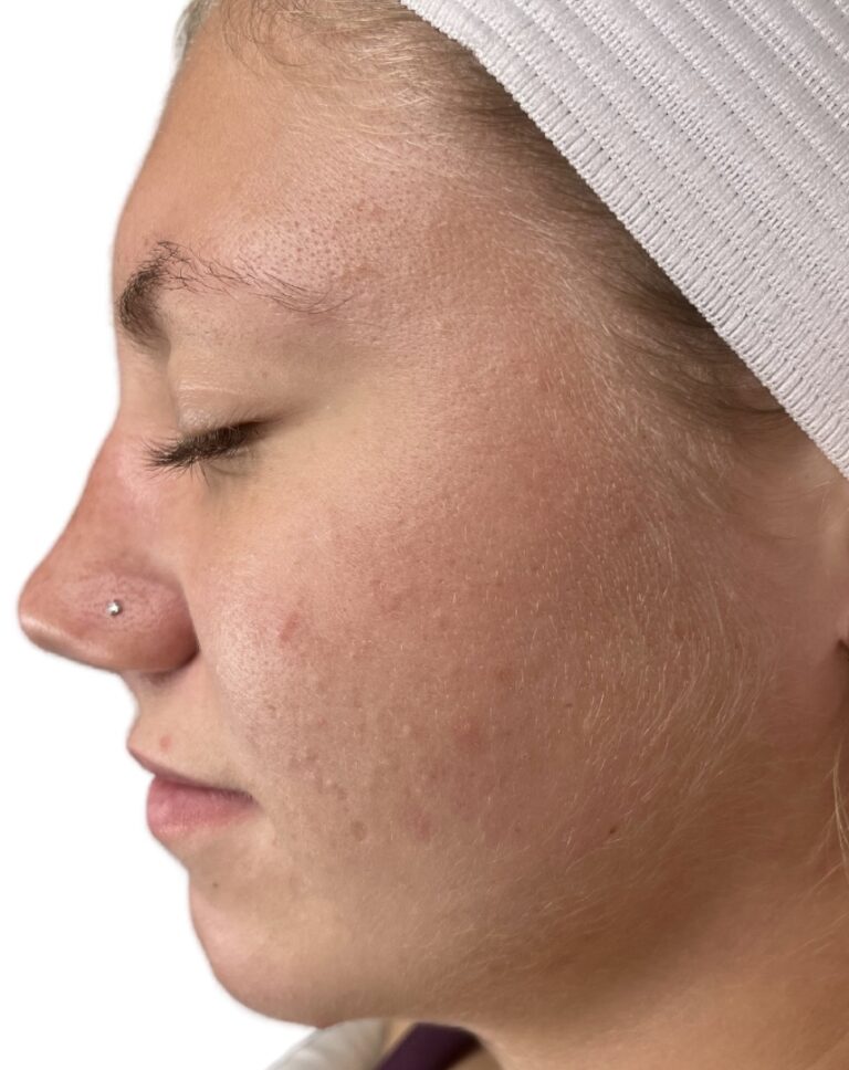 After Image: Acne Chemical Peel - front