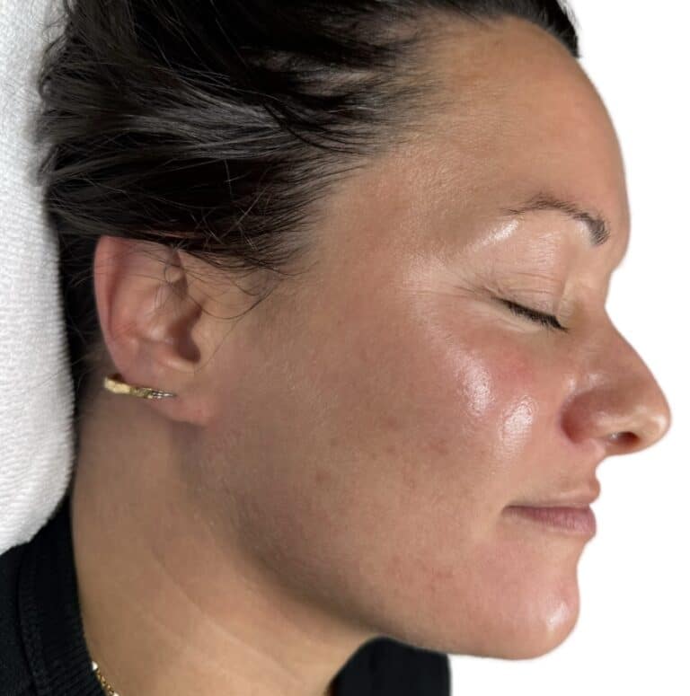 After Image: Acne Chemical Peel -