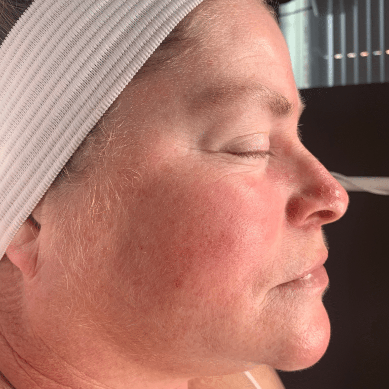 After Image: Chemical Peel - front