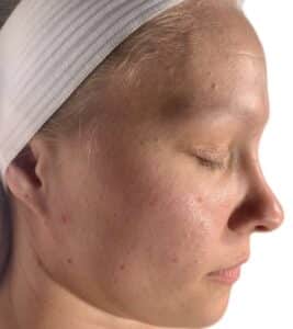 Before Image: Acne Chemical Peel