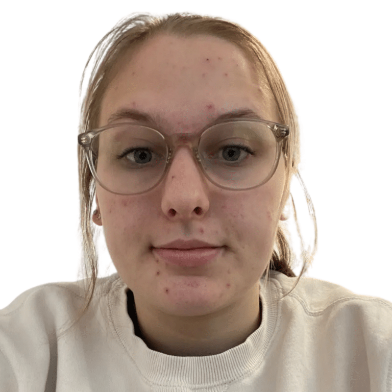 Before Image: Acne Chemical Peel - front