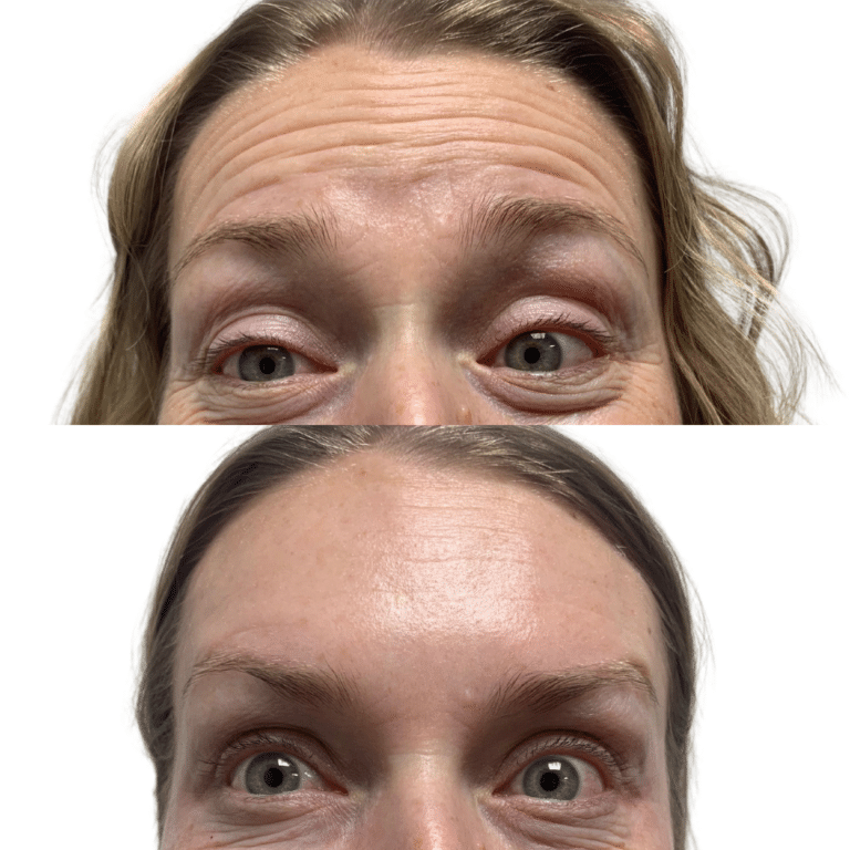 After Image: Botox/Dysport - front