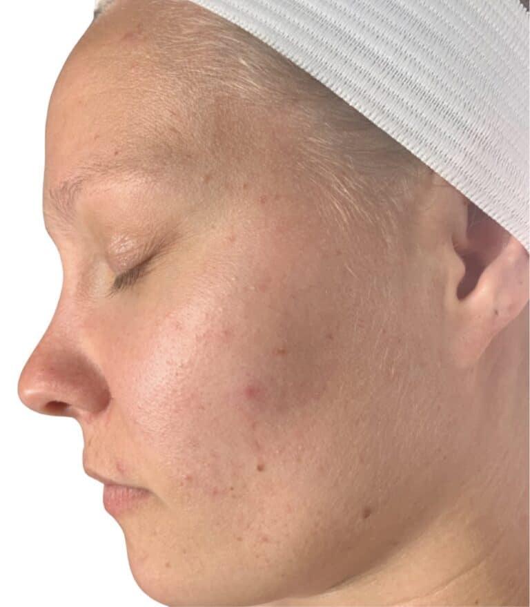 Before Image: Acne Chemical Peel - front