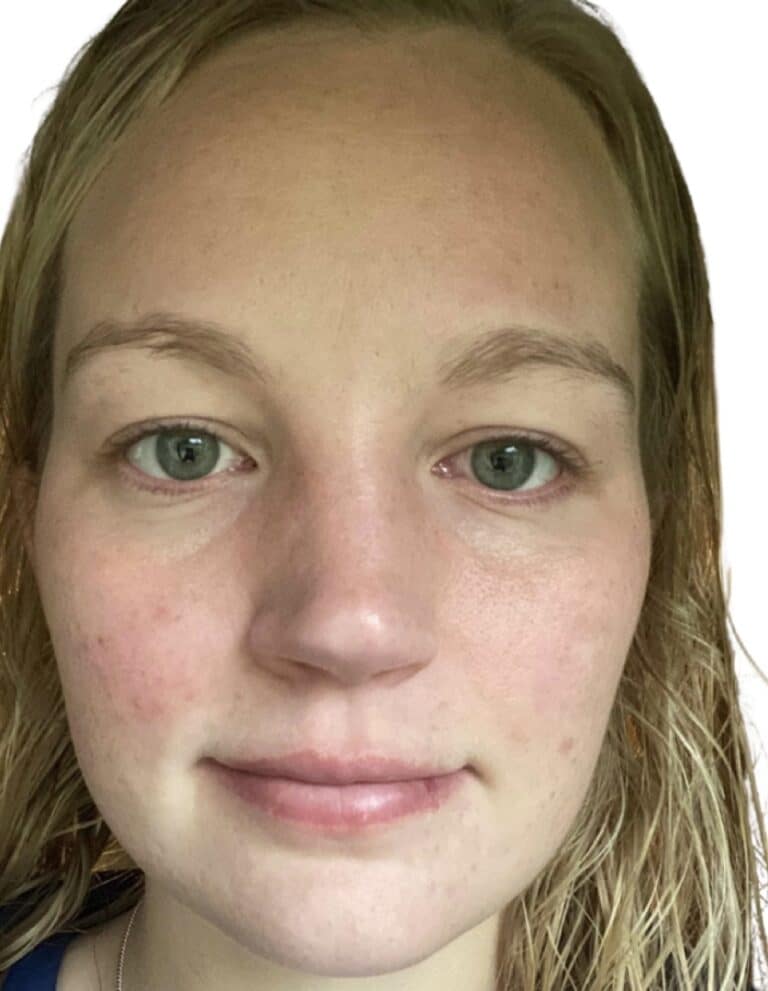 Before Image: Chemical Peel -