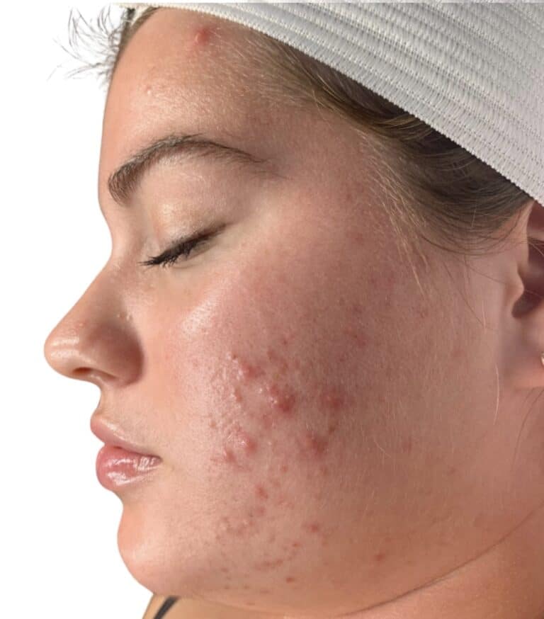 Before Image: Acne Chemical Peel - front