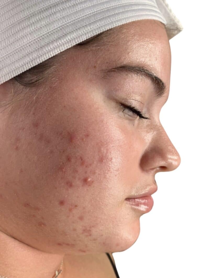 Before Image: Acne Chemical Peel - front