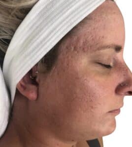 Before Image: Microneedling