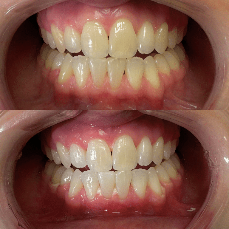 After Image: Teeth Whitening - front