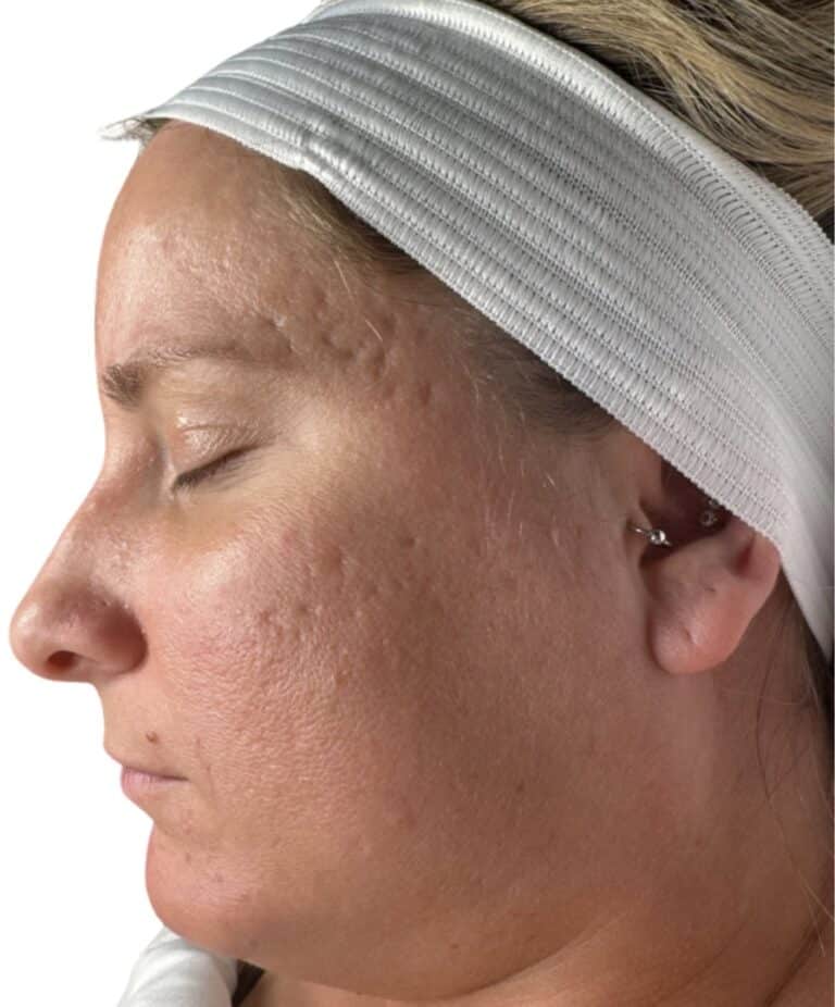 Before Image: Microneedling -