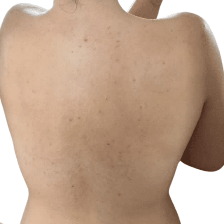 After Image: Back Chemical Peel - front