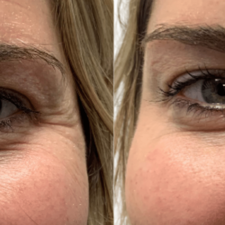 After Image: Botox/Dysport - front