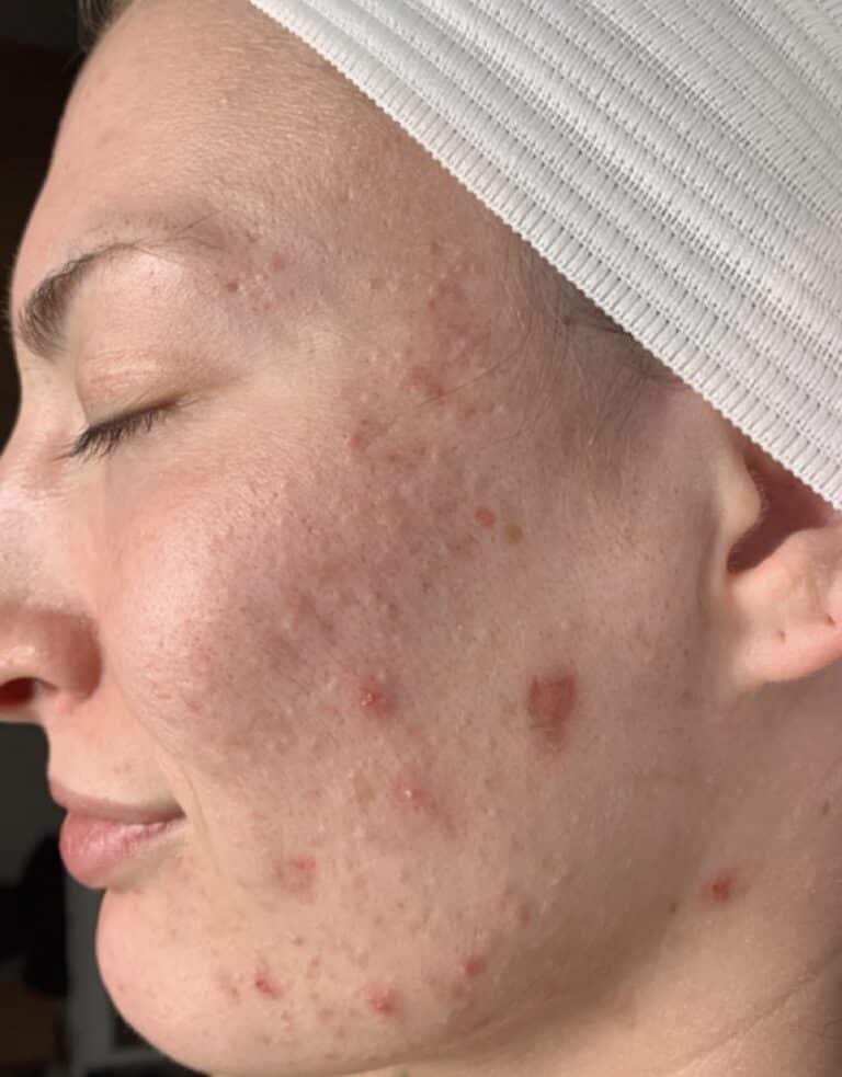 Before Image: Acne Chemical Peel - front
