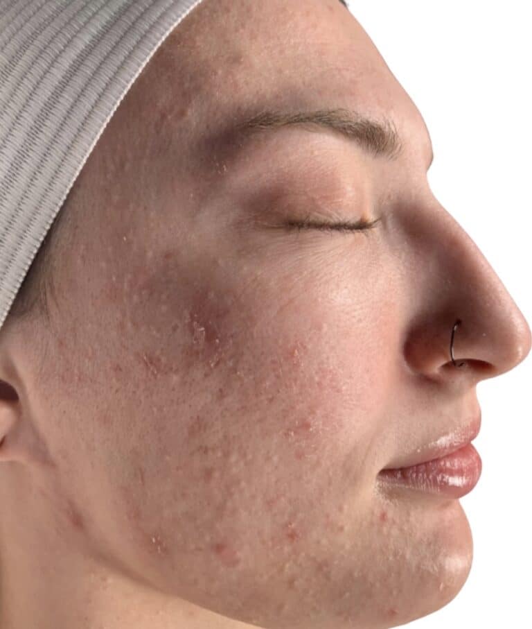 Before Image: Acne Chemical Peel - front