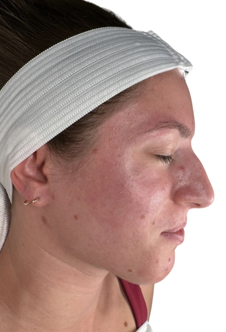 Before Image: Chemical Peel -