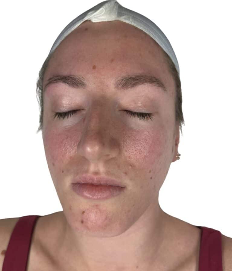 Before Image: Chemical Peel -
