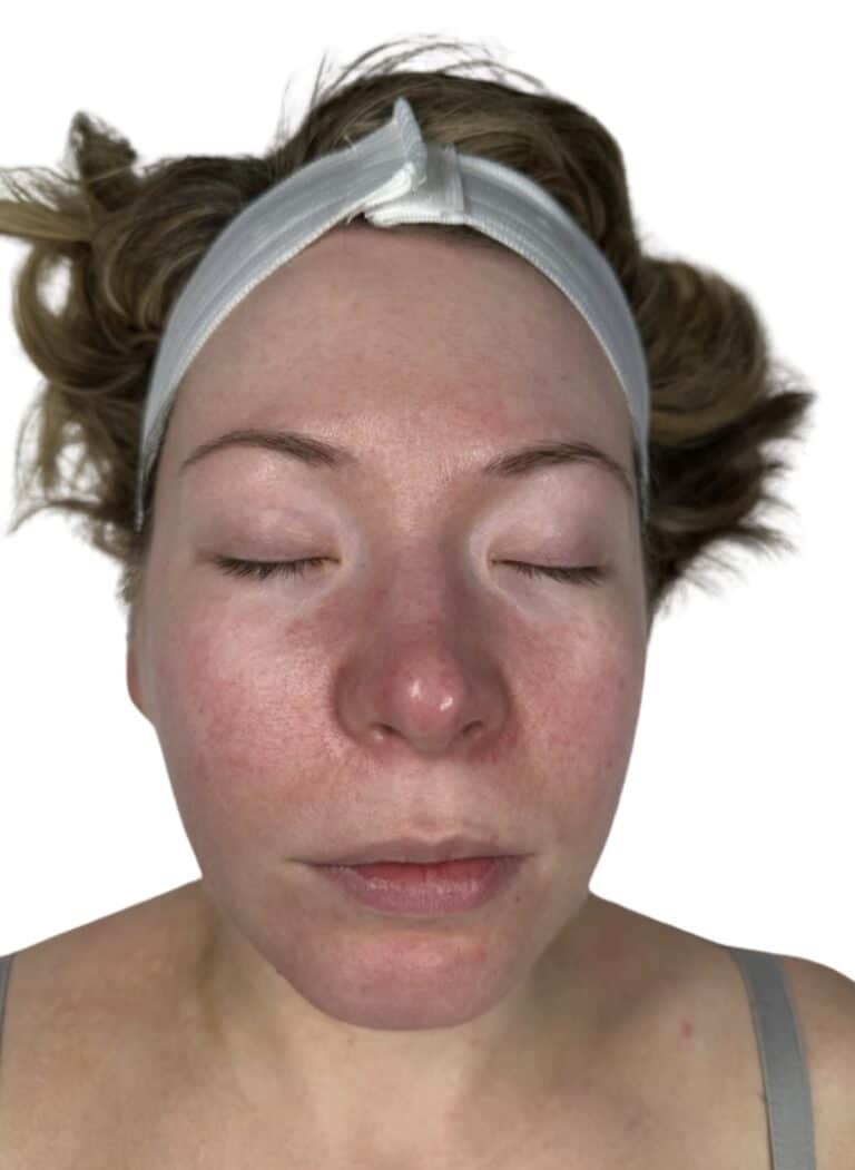 Before Image: Chemical Peel -
