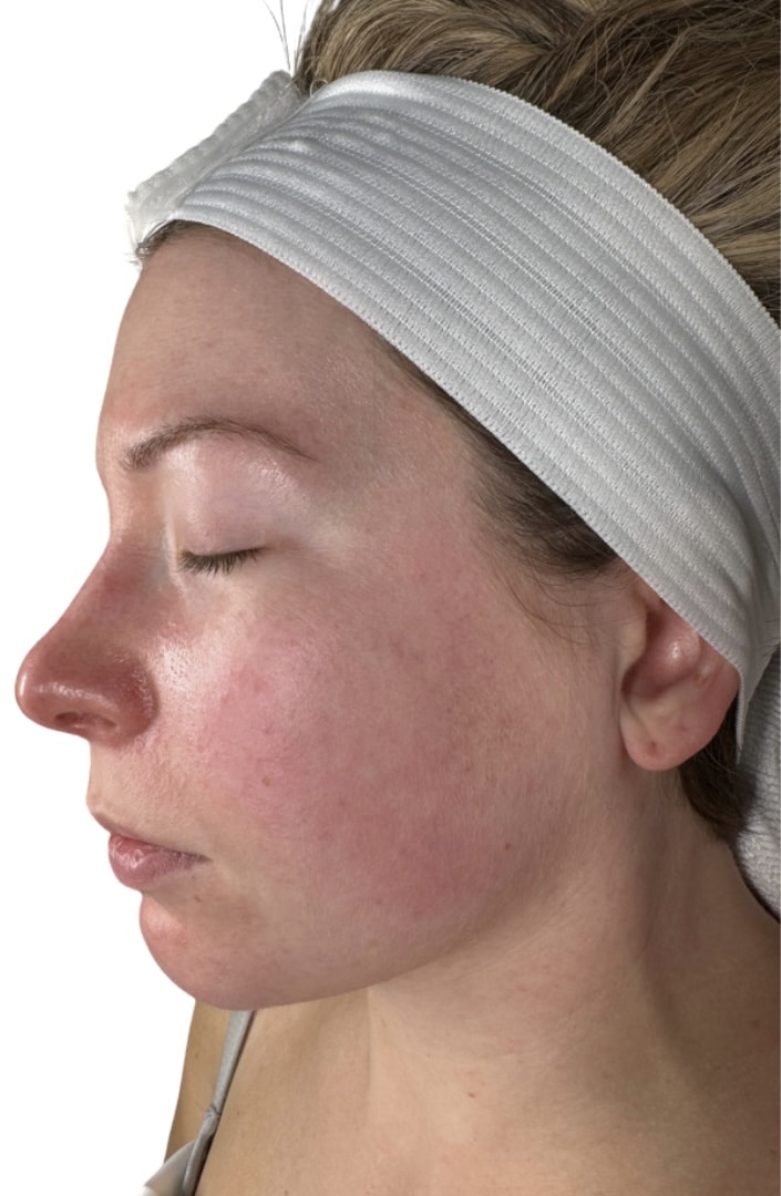 Before Image: Chemical Peel - front