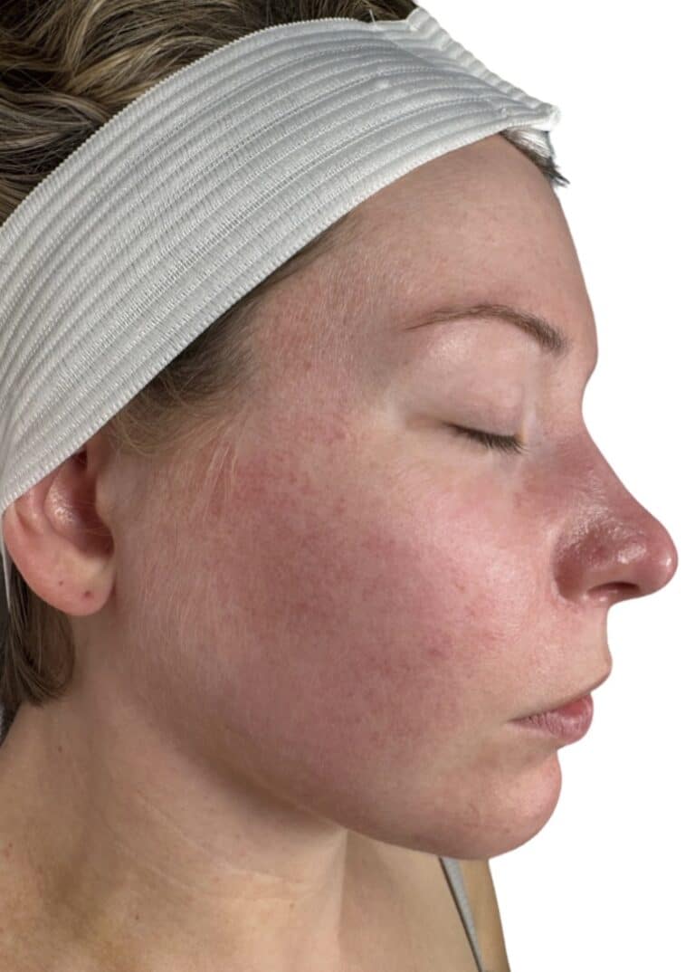 Before Image: Chemical Peel -