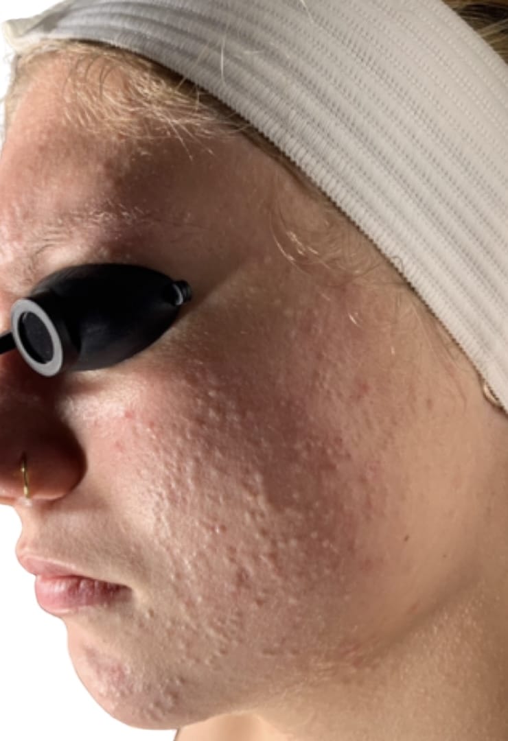 Before Image: Acne Chemical Peel - front
