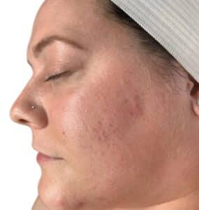 Before Image: Acne Chemical Peel
