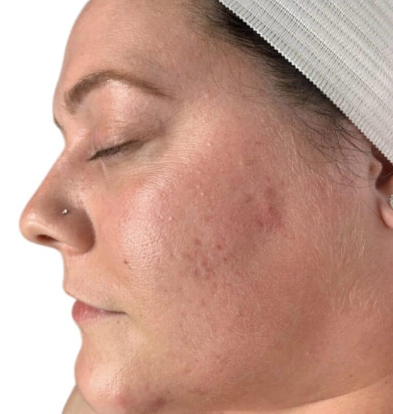 Before Image: Acne Chemical Peel - front