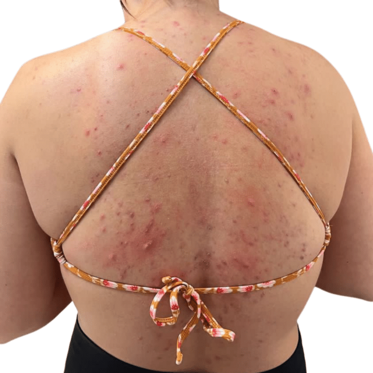 Before Image: Back Chemical Peel - front