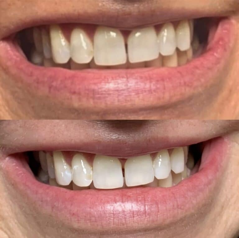 After Image: Teeth Whitening - front