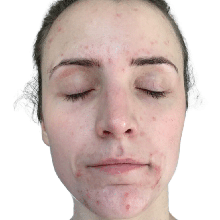 Before Image: Acne Chemical Peel - front