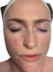 Before Image: Acne Chemical Peel
