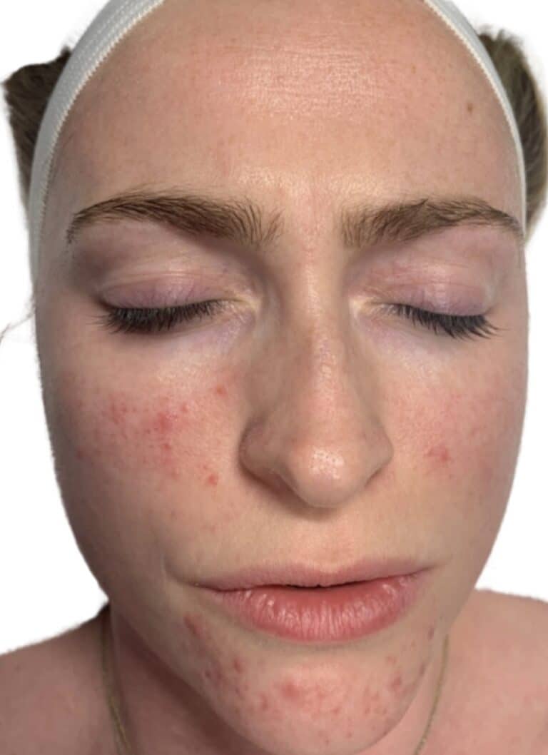 Before Image: Acne Chemical Peel - front