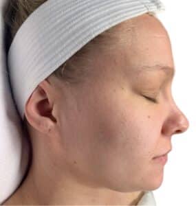 After Image: Acne Chemical Peel