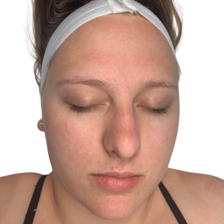 After Image: Acne Chemical Peel - front