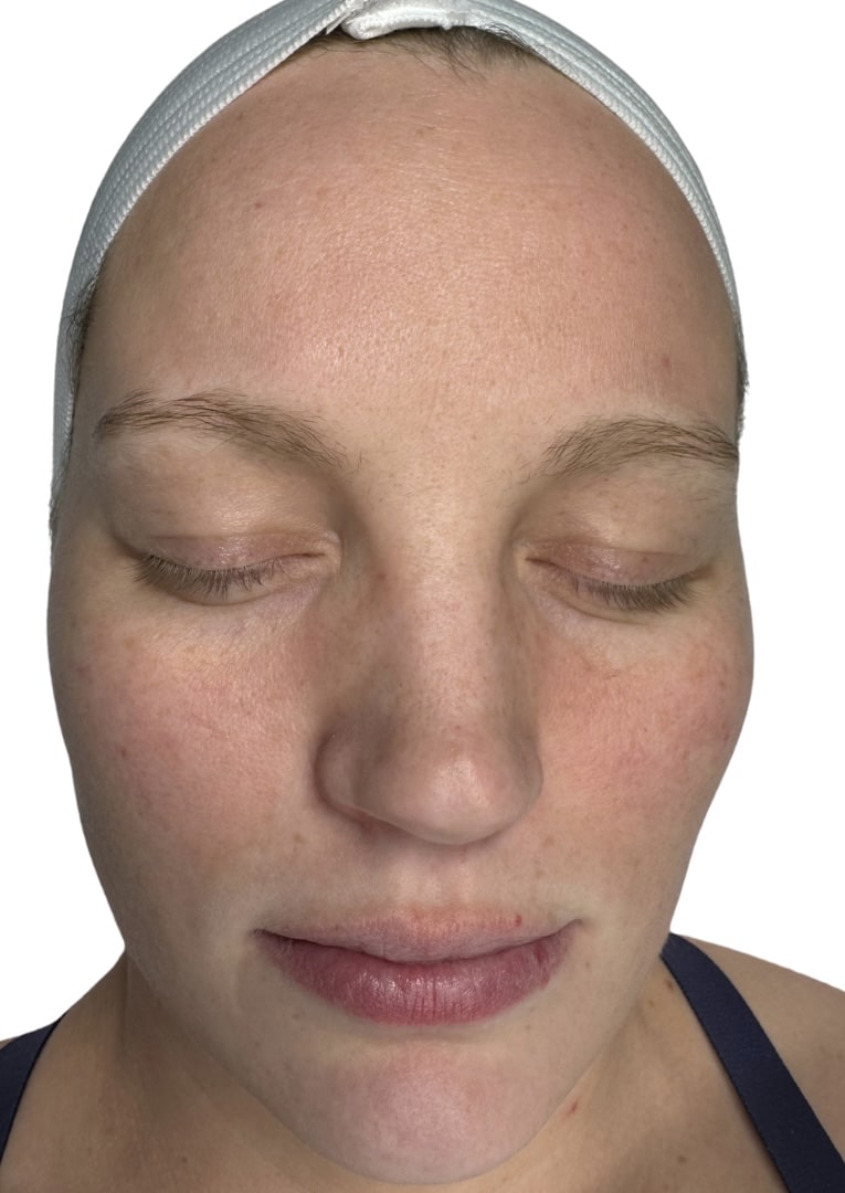 After Image: Chemical Peel -