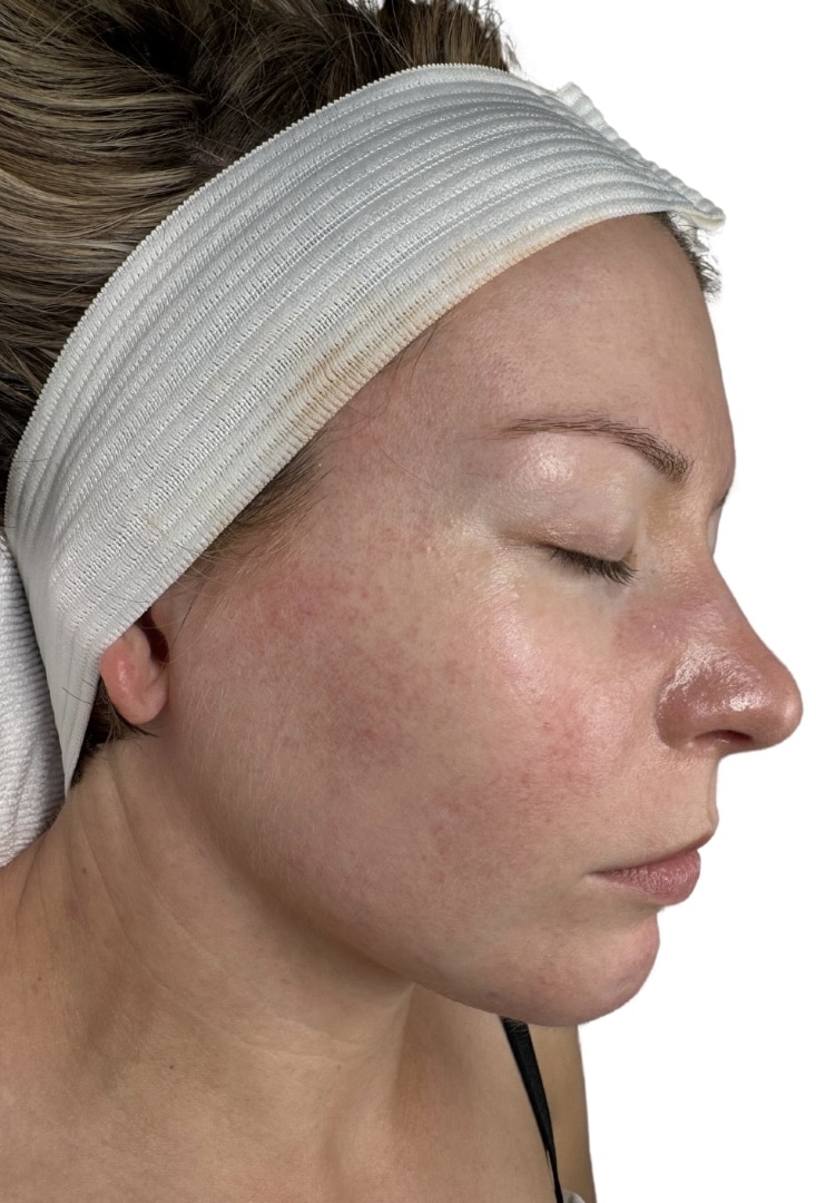 After Image: Chemical Peel -