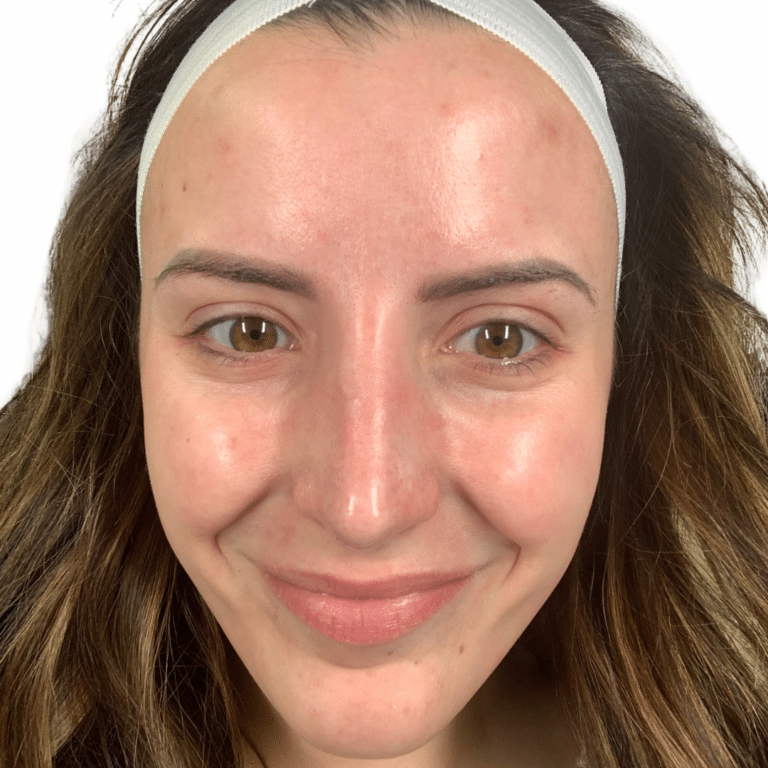After Image: Acne Chemical Peel - front