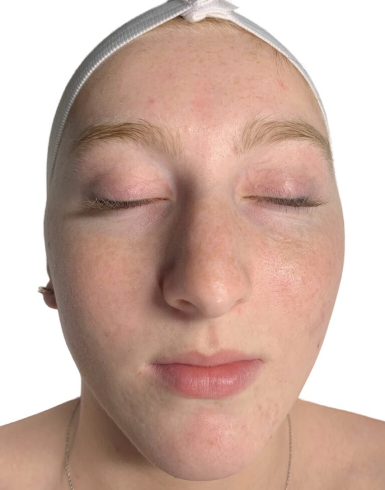 After Image: Acne Chemical Peel - front