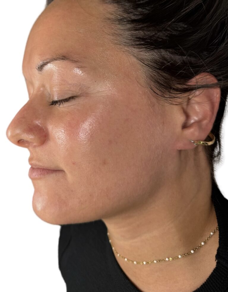 After Image: Acne Chemical Peel - front