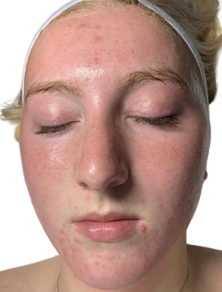 Before Image: Acne Chemical Peel - front