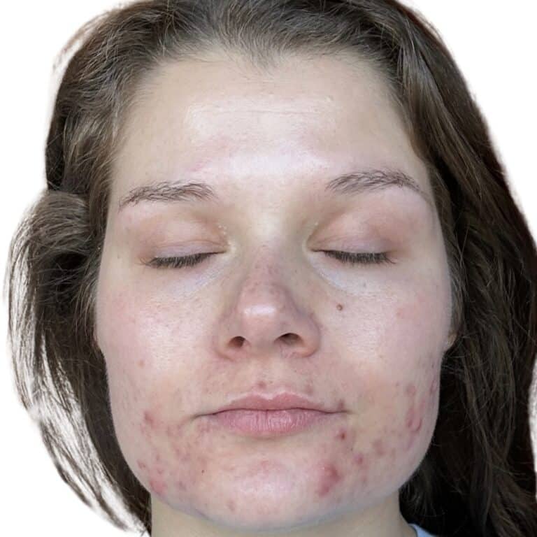 Before Image: Acne Chemical Peel - other