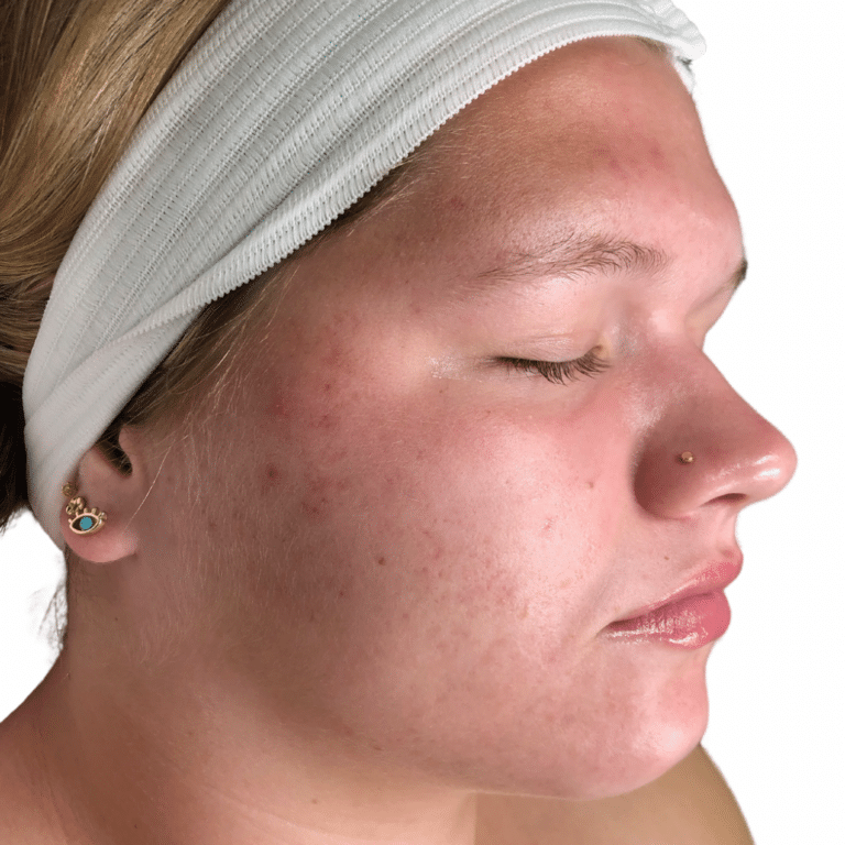 After Image: Acne Chemical Peel - front