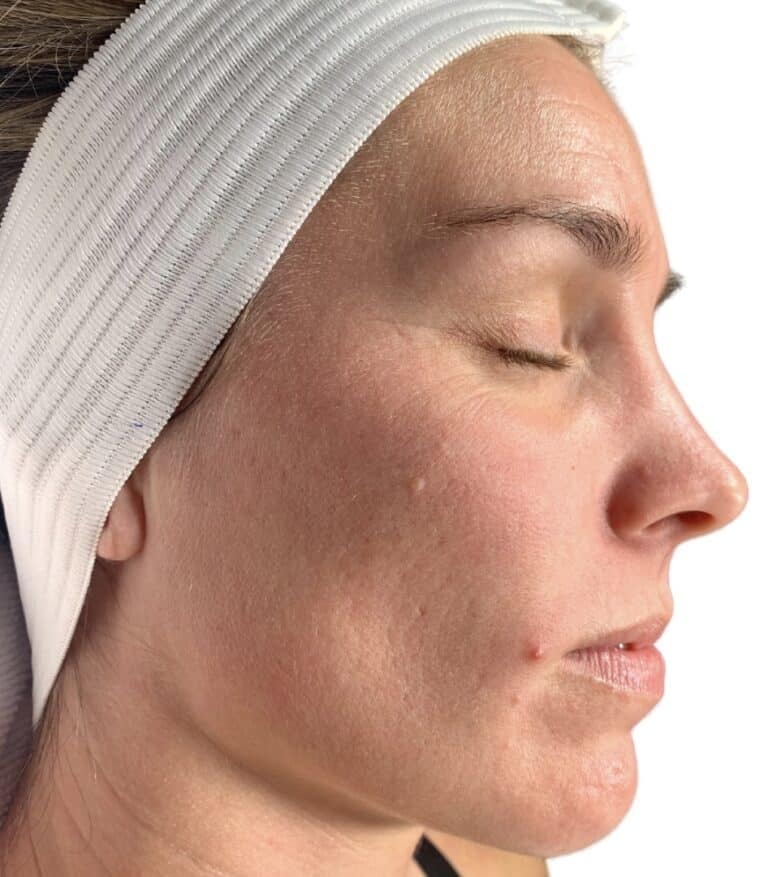 After Image: Acne Chemical Peel - other