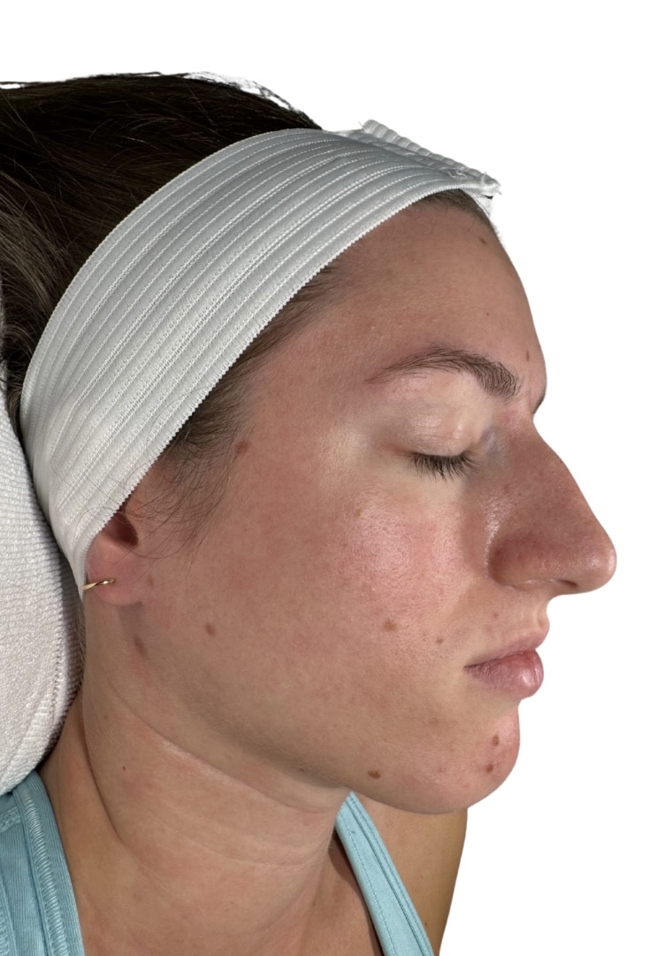 After Image: Chemical Peel -