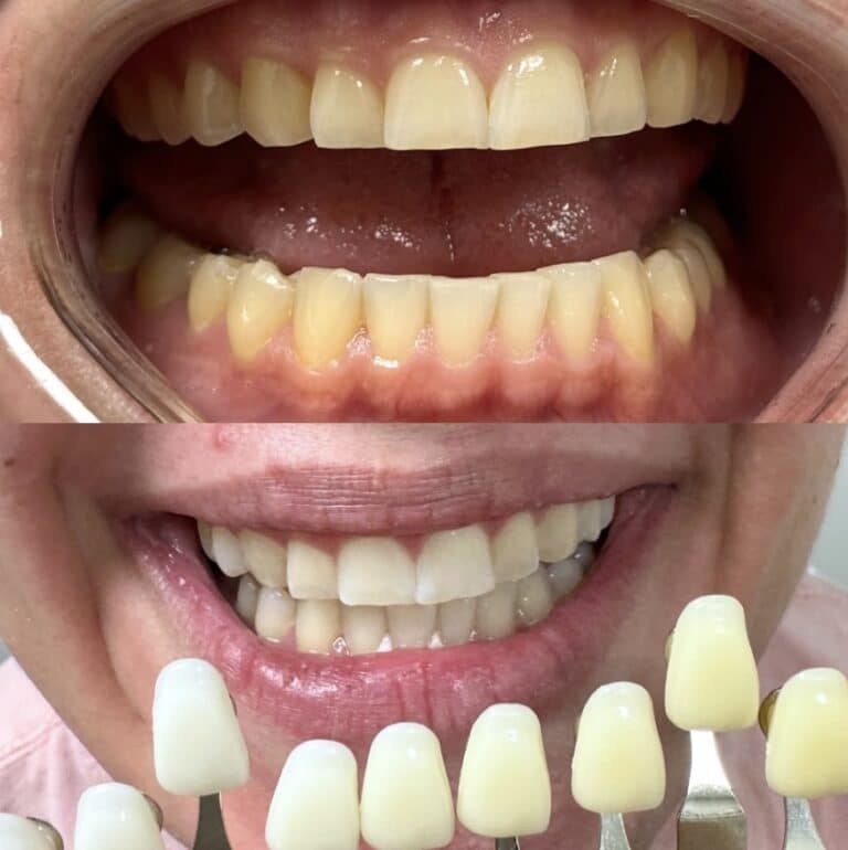 Before Image: Teeth Whitening - front