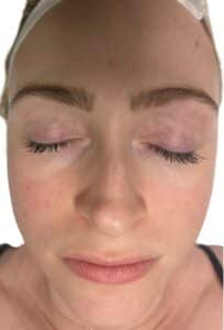 After Image: Acne Chemical Peel